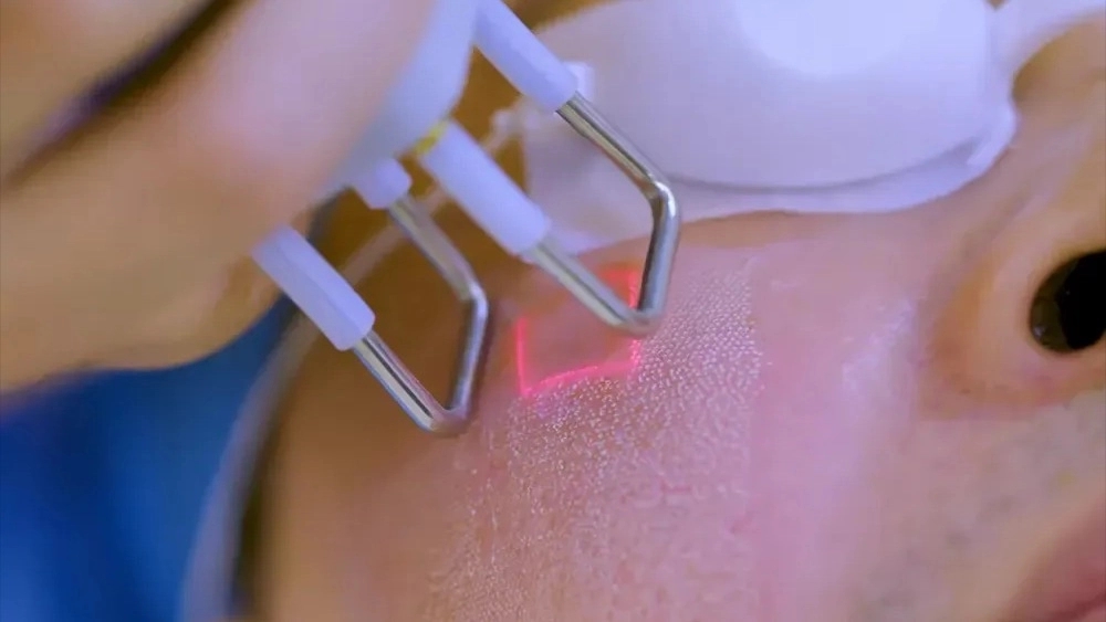 لیزر بدون درد با دستگاه پیشرفته در مرکز زیبایی مریم محمدی لیزر بدون درد با دستگاه پیشرفته در مرکز زیبایی مریم محمدی